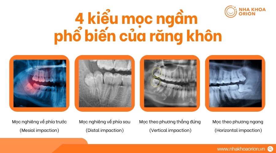 Răng kh&ocirc;n mọc ngầm bị giữ dưới nướu hoặc xương h&agrave;m v&agrave; kh&ocirc;ng thể trồi l&ecirc;n b&igrave;nh thường