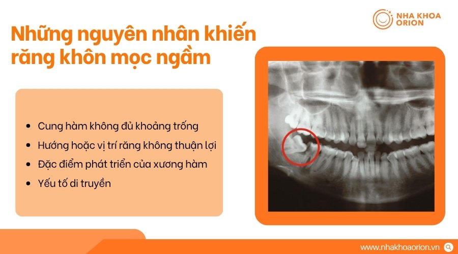 Răng kh&ocirc;n mọc ngầm thường do thiếu chỗ, cấu tr&uacute;c xương, nướu v&agrave; di truyền