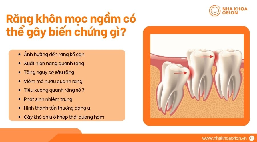 Răng kh&ocirc;n mọc ngầm c&oacute; thể g&acirc;y tổn thương răng v&agrave; m&ocirc; xung quanh