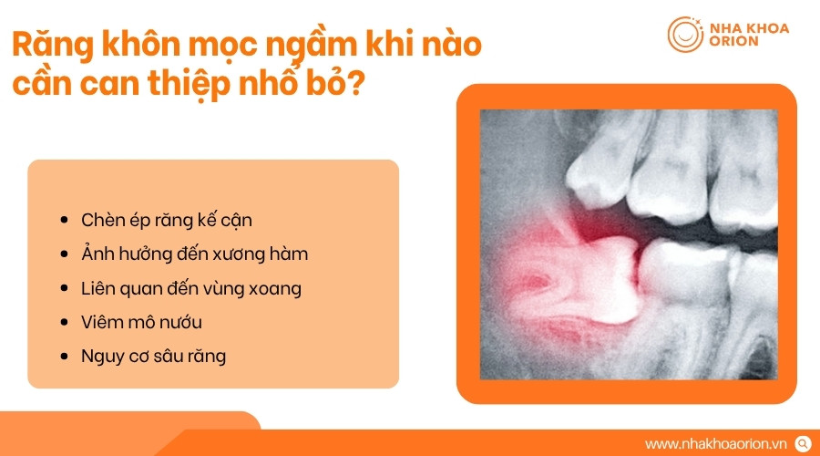 B&aacute;c sĩ quyết định nhổ răng kh&ocirc;n dựa tr&ecirc;n triệu chứng, vị tr&iacute; răng v&agrave; nguy cơ biến chứng