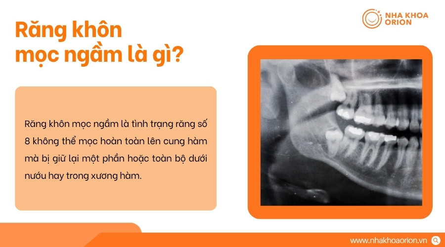 Răng kh&ocirc;n mọc ngầm bị giữ dưới nướu hoặc xương h&agrave;m v&agrave; kh&ocirc;ng thể trồi l&ecirc;n b&igrave;nh thường