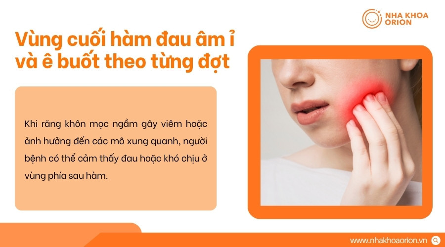 Cơn đau do răng kh&ocirc;n mọc ngầm thường xuất hiện &acirc;m ỉ v&agrave; t&aacute;i diễn tại v&ugrave;ng cuối h&agrave;m