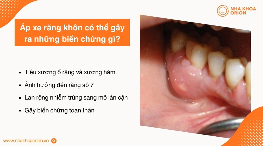 &Aacute;p xe k&eacute;o d&agrave;i c&oacute; thể g&acirc;y tổn thương răng l&acirc;n cận, xương h&agrave;m v&agrave; c&aacute;c m&ocirc; xung quanh