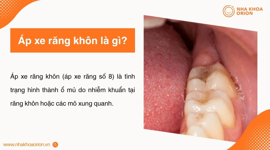 &Aacute;p xe răng kh&ocirc;n h&igrave;nh th&agrave;nh khi vi khuẩn g&acirc;y nhiễm tr&ugrave;ng v&agrave; tạo ổ mủ quanh răng số 8