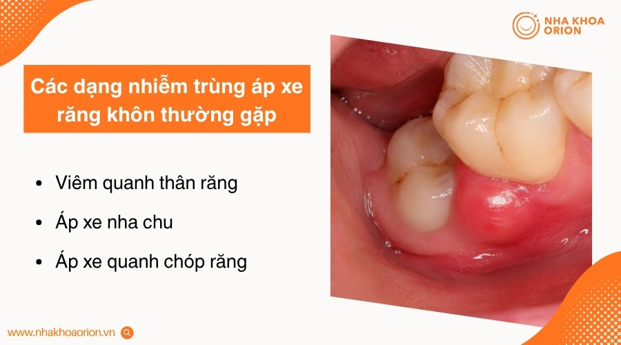 &Aacute;p xe răng kh&ocirc;n được ph&acirc;n loại dựa tr&ecirc;n vị tr&iacute; h&igrave;nh th&agrave;nh v&agrave; m&ocirc; răng bị ảnh hưởng