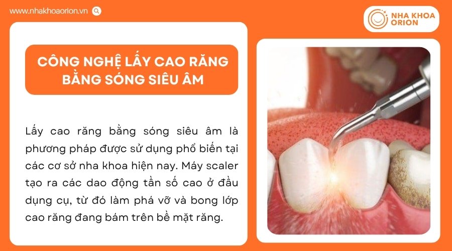 Sóng siêu âm giúp làm bong cao răng bằng dao động tần số cao