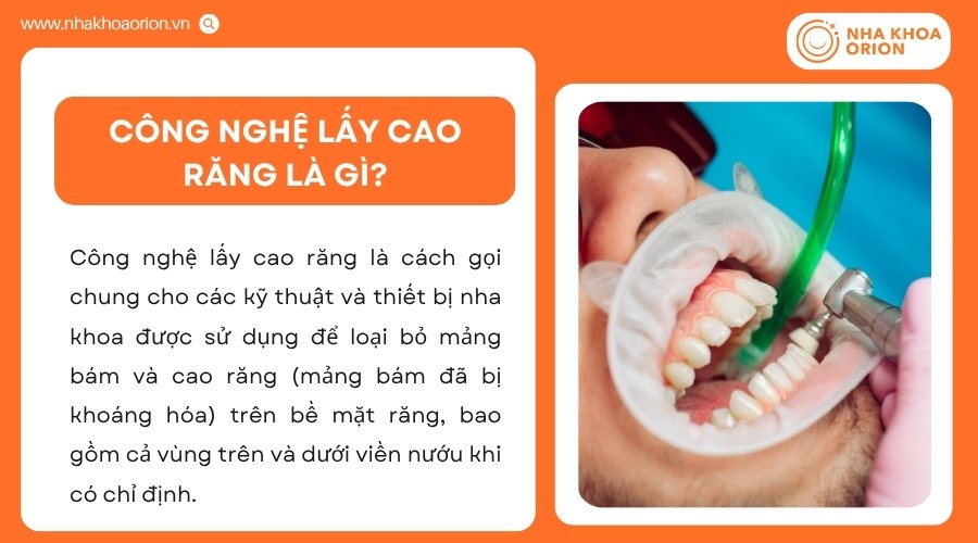 Công nghệ lấy cao răng là kỹ thuật nha khoa hỗ trợ loại bỏ cao răng hiệu quả