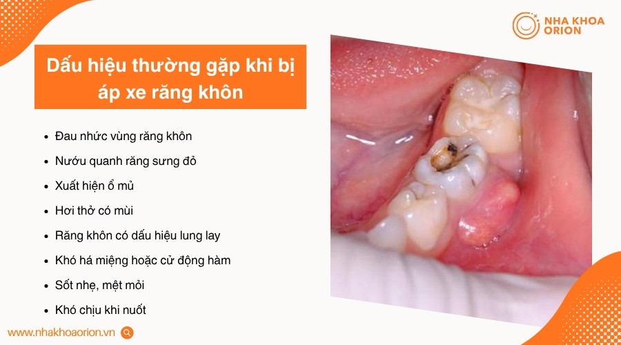 &Aacute;p xe răng kh&ocirc;n thường g&acirc;y c&aacute;c biểu hiện r&otilde; rệt tại răng, nướu v&agrave; to&agrave;n th&acirc;n
