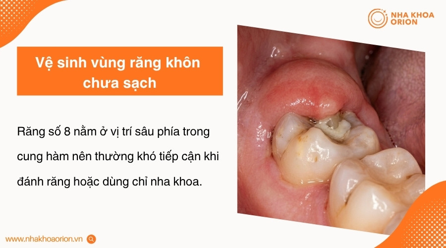 Vệ sinh kh&ocirc;ng kỹ khiến mảng b&aacute;m v&agrave; vi khuẩn dễ t&iacute;ch tụ tại khu vực răng số 8