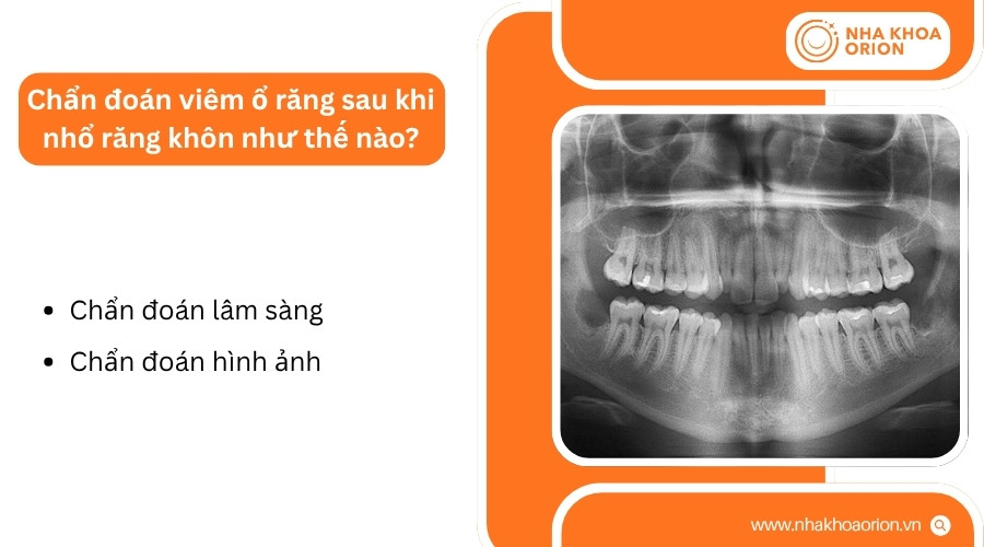 B&aacute;c sĩ chẩn đo&aacute;n vi&ecirc;m ổ răng bằng thăm kh&aacute;m l&acirc;m s&agrave;ng v&agrave; chẩn đo&aacute;n h&igrave;nh ảnh khi cần