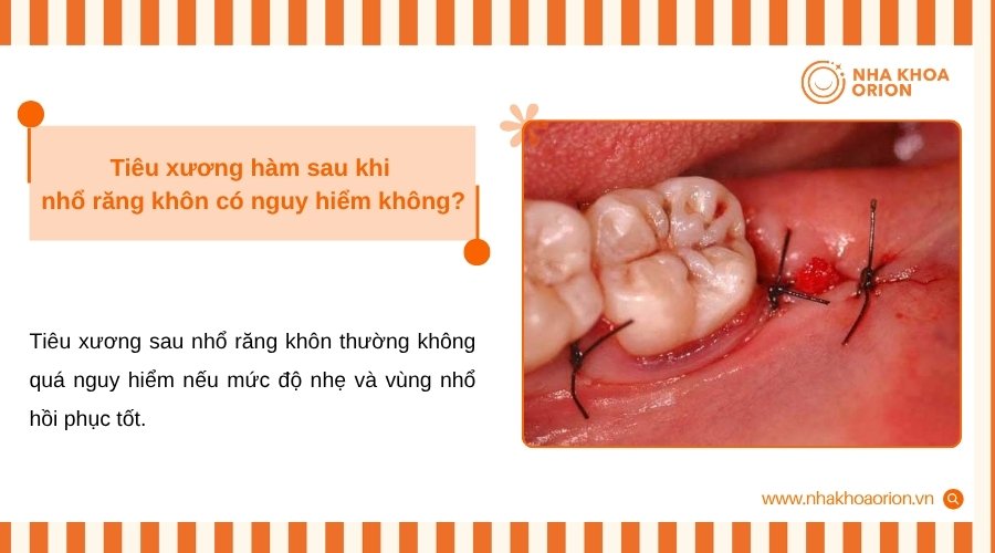 Ti&ecirc;u xương sau nhổ răng kh&ocirc;n đ&aacute;ng lo khi ảnh hưởng răng số 7 hoặc m&ocirc; nha chu
