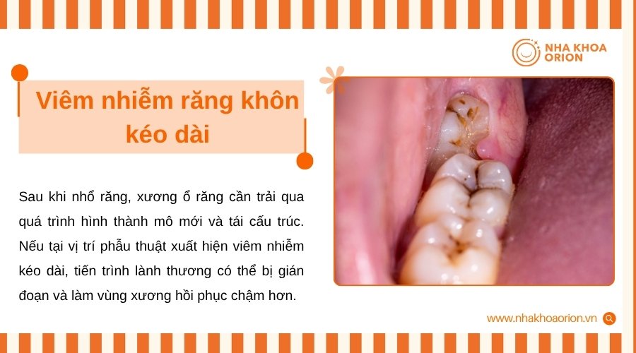 Vi&ecirc;m nhiễm k&eacute;o d&agrave;i l&agrave;m tổn thương m&ocirc; nha chu v&agrave; xương ổ răng trước khi nhổ