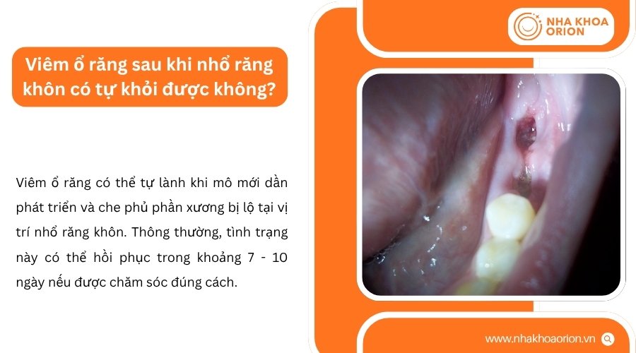 Vi&ecirc;m ổ răng c&oacute; thể tự l&agrave;nh nhưng người bệnh vẫn n&ecirc;n được nha sĩ kiểm tra