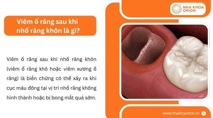 Vi&ecirc;m ổ răng xảy ra khi cục m&aacute;u đ&ocirc;ng mất sớm v&agrave; l&agrave;m lộ xương b&ecirc;n dưới
