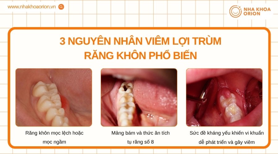 Răng kh&ocirc;n mọc bất thường v&agrave; vệ sinh k&eacute;m l&agrave; những yếu tố dễ g&acirc;y vi&ecirc;m lợi tr&ugrave;m