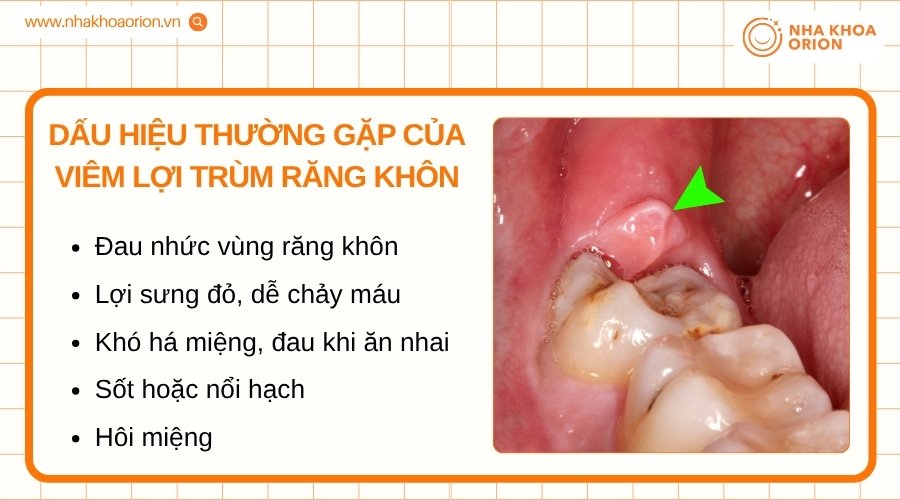 Vi&ecirc;m lợi tr&ugrave;m c&oacute; thể g&acirc;y đau, sưng nướu, h&ocirc;i miệng v&agrave; nhiều triệu chứng kh&oacute; chịu kh&aacute;c