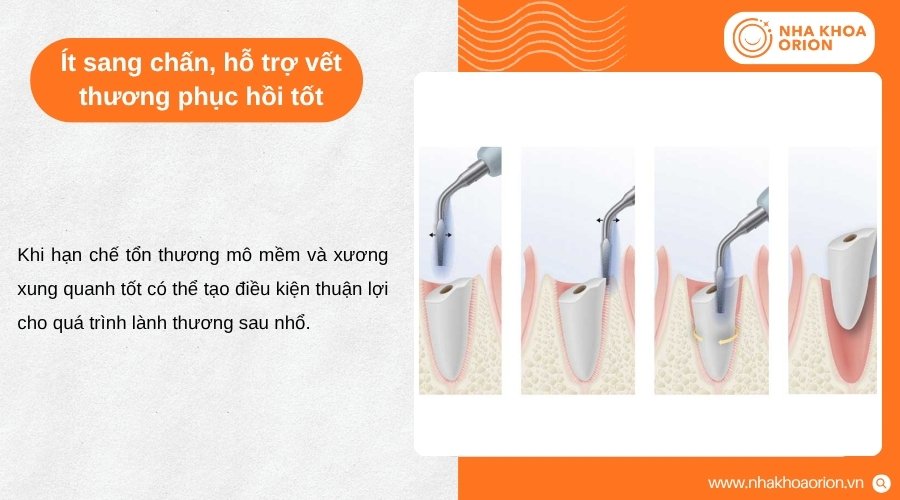 Piezotome hạn chế tổn thương mô, tạo điều kiện để vùng nhổ răng phục hồi thuận lợi hơn