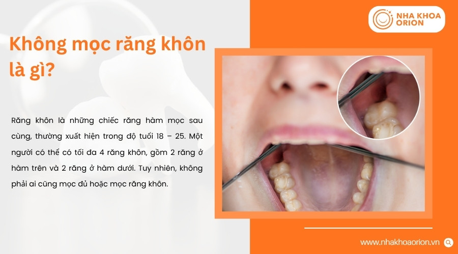 Kh&ocirc;ng mọc răng kh&ocirc;n l&agrave; t&igrave;nh trạng một người kh&ocirc;ng xuất hiện răng số 8 tr&ecirc;n cung h&agrave;m