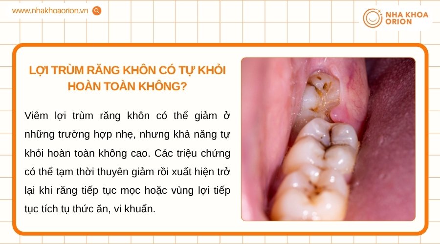 Vi&ecirc;m lợi tr&ugrave;m c&oacute; thể giảm tạm thời nhưng thường kh&ocirc;ng tự hết nếu c&ograve;n nguy&ecirc;n nh&acirc;n