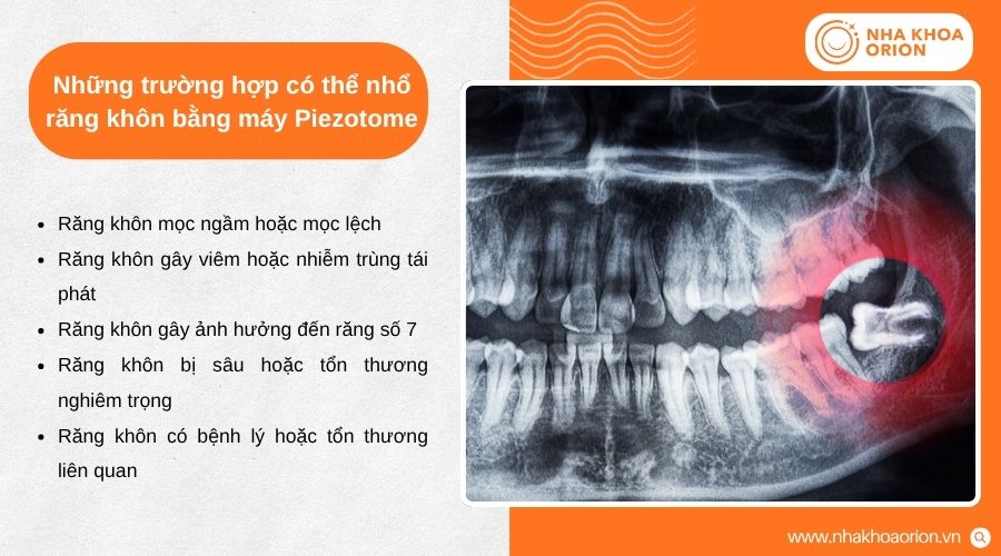 Bác sĩ có thể chỉ định Piezotome cho nhiều tình trạng răng khôn cần can thiệp phẫu thuật