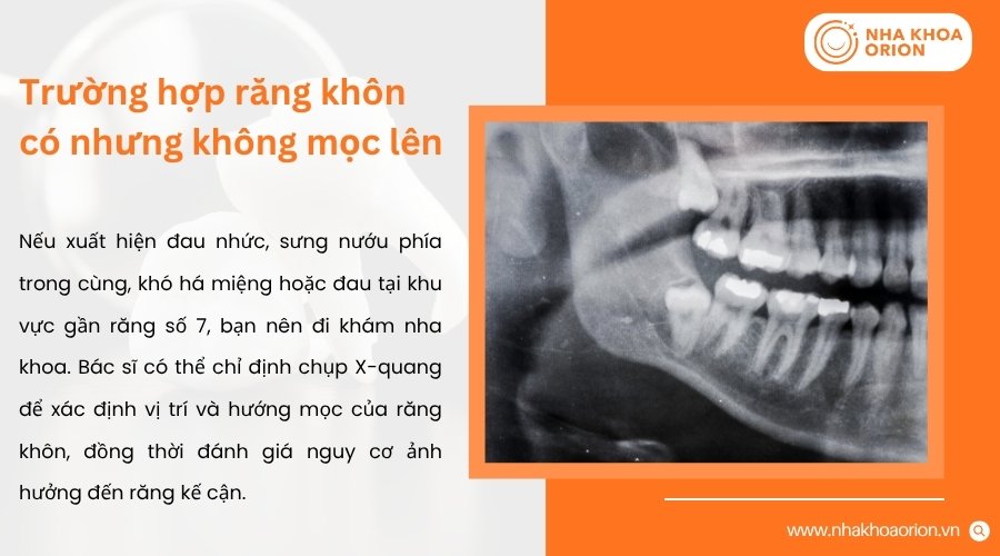 Răng kh&ocirc;n c&oacute; thể mọc nhưng bị giữ lại dưới nướu hoặc trong xương h&agrave;m