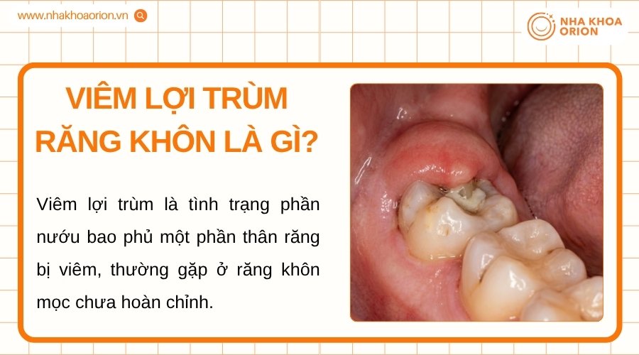 Vi&ecirc;m lợi tr&ugrave;m răng kh&ocirc;n l&agrave; t&igrave;nh trạng khi nướu bao phủ một phần răng kh&ocirc;n đang mọc