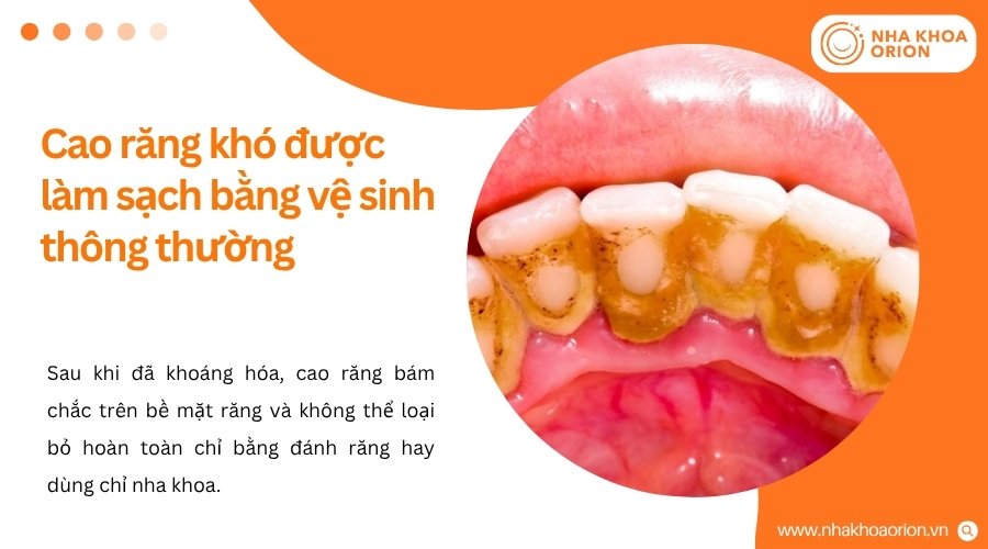 Cao răng bám chắc nên vi khuẩn gây mùi khó được loại bỏ bằng vệ sinh thông thường