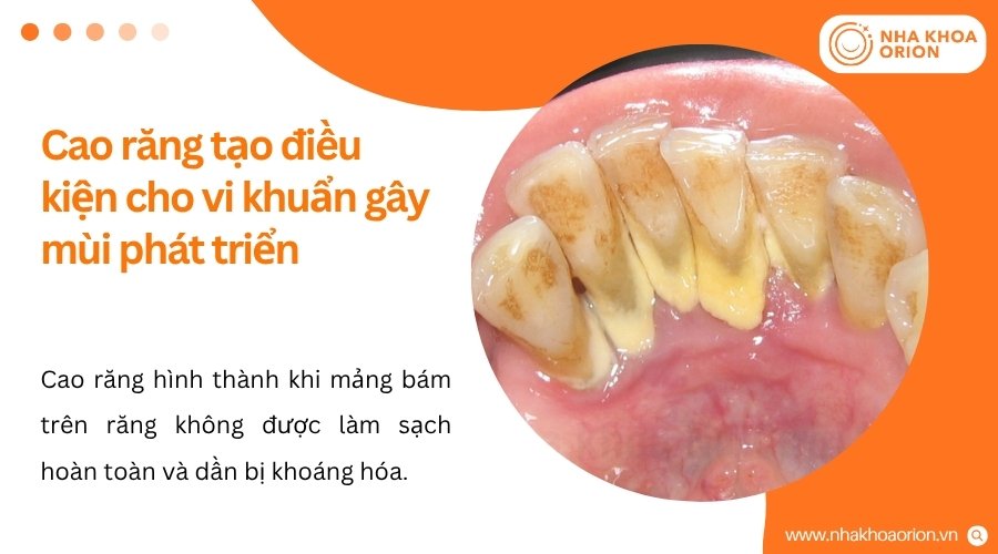 Bề mặt cao răng giữ lại vi khuẩn và cặn thức ăn, từ đó tạo mùi khó chịu