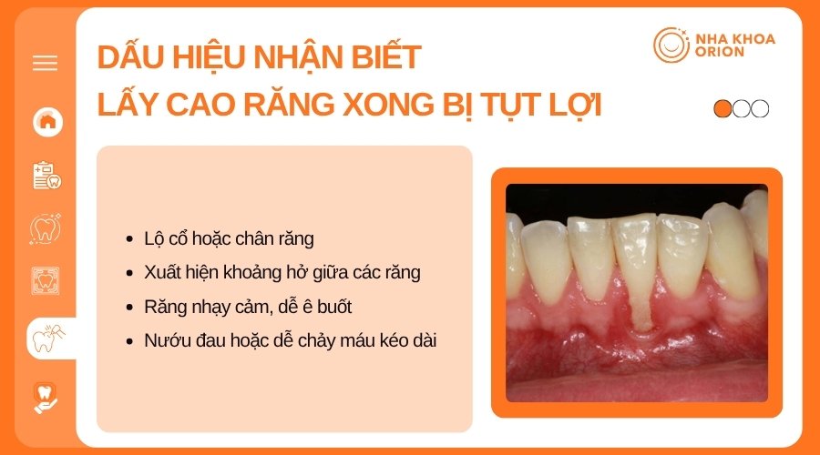 Tụt lợi sau cạo v&ocirc;i c&oacute; thể g&acirc;y hở ch&acirc;n răng, &ecirc; buốt v&agrave; chảy m&aacute;u nướu