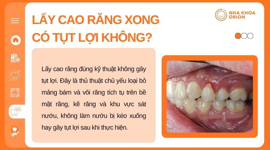 Lấy cao răng đ&uacute;ng kỹ thuật kh&ocirc;ng g&acirc;y tụt lợi v&agrave; gi&uacute;p loại bỏ mảng b&aacute;m, v&ocirc;i răng