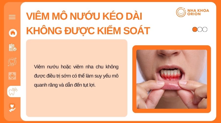 Vi&ecirc;m nướu hoặc vi&ecirc;m nha chu k&eacute;o d&agrave;i c&oacute; thể l&agrave;m nướu suy yếu v&agrave; tụt dần