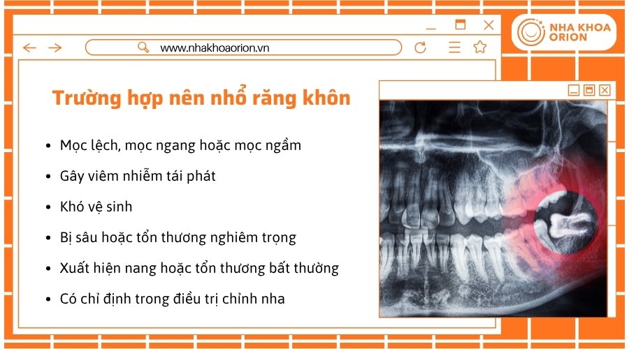 Răng khôn cần được cân nhắc nhổ khi gây ảnh hưởng đến các răng xung quanh
