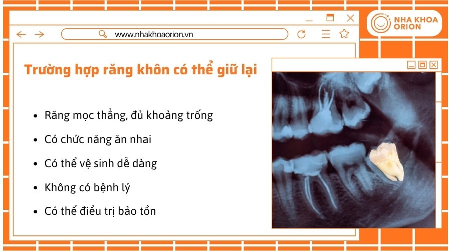 Răng khôn khỏe mạnh, mọc đúng vị trí và dễ vệ sinh có thể được giữ lại
