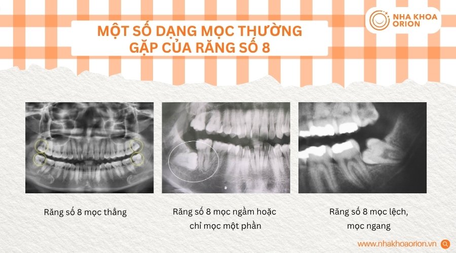 Răng số 8 c&oacute; thể mọc thẳng, mọc ngầm, mọc một phần hoặc mọc lệch