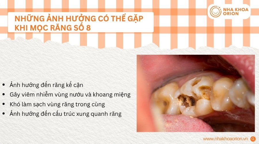Răng số 8 mọc bất thường c&oacute; thể ảnh hưởng đến răng kế cận v&agrave; nướu