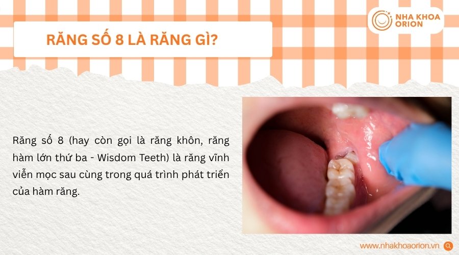 Răng số 8 l&agrave; răng kh&ocirc;n mọc sau c&ugrave;ng trong h&agrave;m