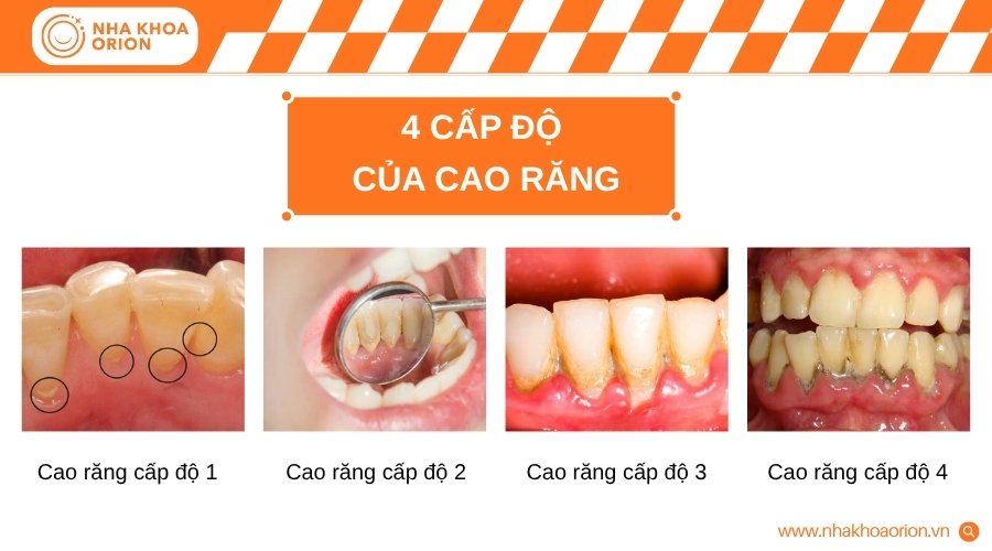 Cao răng phát triển qua bốn cấp độ với mức độ tích tụ ngày càng nghiêm trọng