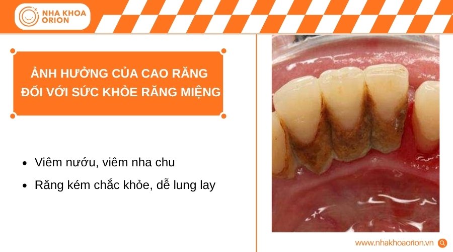 Cao răng không chỉ làm mất thẩm mỹ mà còn có thể gây ra nhiều vấn đề răng miệng