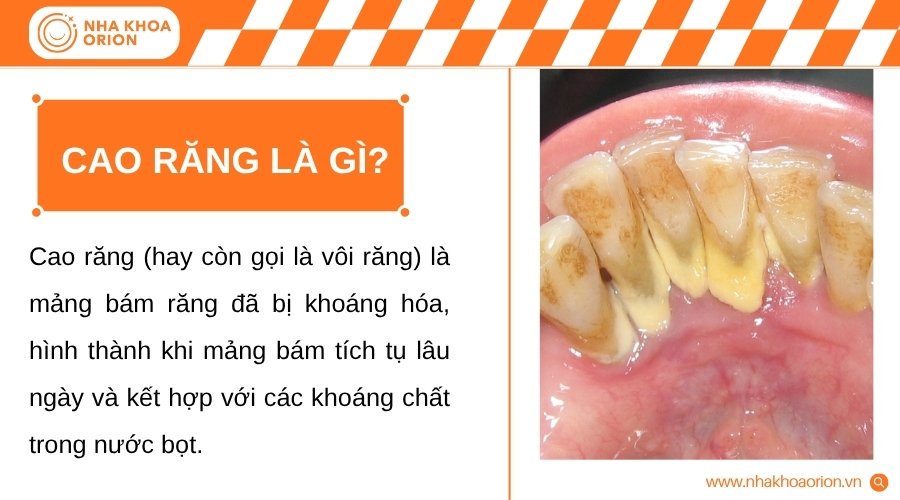 Cao răng hình thành từ mảng bám khoáng hóa và ảnh hưởng đến sức khỏe răng miệng