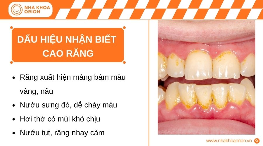Cao răng thường biểu hiện qua những thay đổi ở răng và nướu