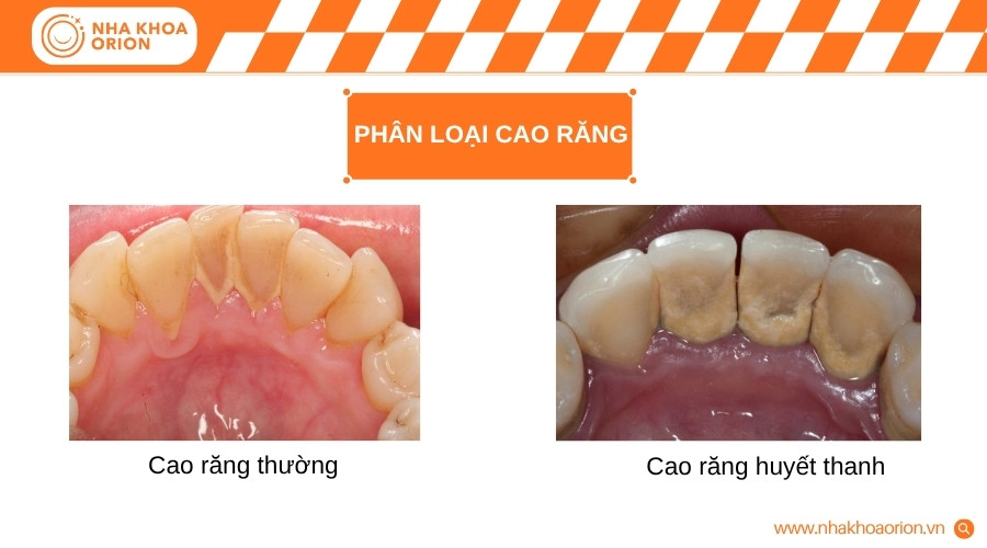 Cao răng được chia thành hai loại dựa trên vị trí và đặc điểm nhận biết