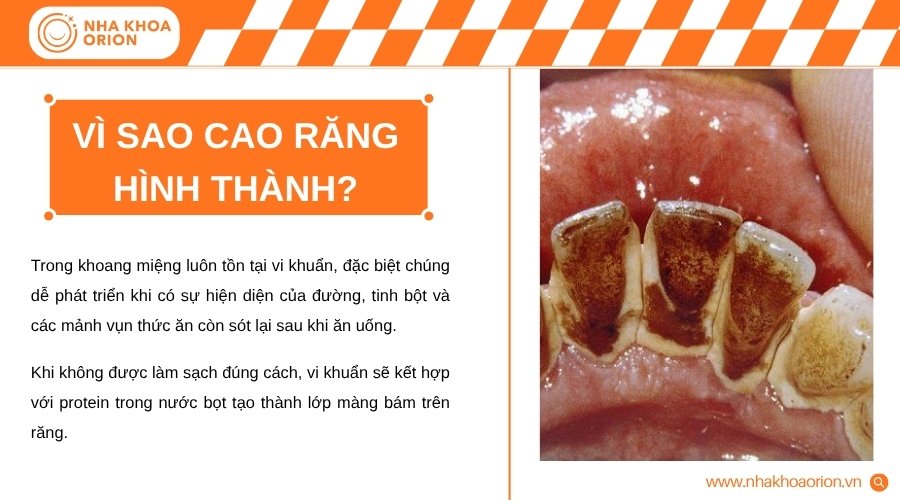 Cao răng hình thành do vi khuẩn, thức ăn thừa và khoáng chất tích tụ lâu ngày