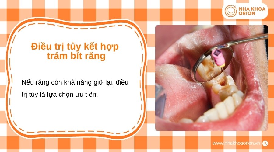 Điều trị tủy giúp loại bỏ phần mô bị tổn thương