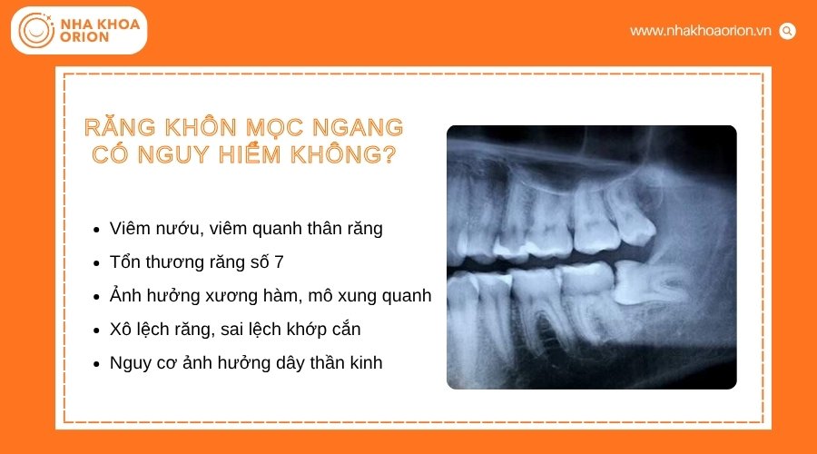 Răng kh&ocirc;n mọc ngang c&oacute; thể g&acirc;y vi&ecirc;m nhiễm v&agrave; ảnh hưởng đến sức khỏe răng miệng