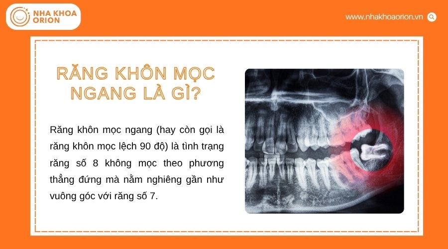 Răng kh&ocirc;n mọc ngang thường nằm nghi&ecirc;ng v&agrave; t&aacute;c động đến răng số 7 b&ecirc;n cạnh