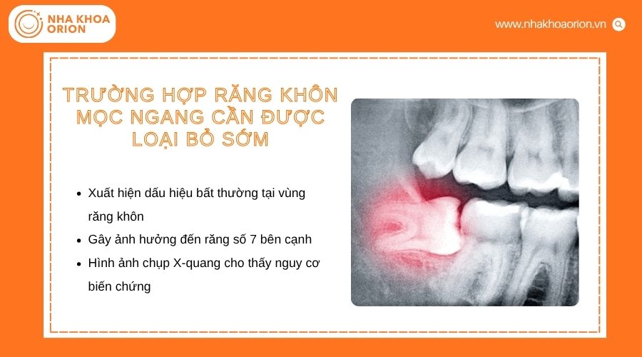 Răng kh&ocirc;n mọc ngang cần nhổ khi g&acirc;y đau hoặc ảnh hưởng răng kế cận