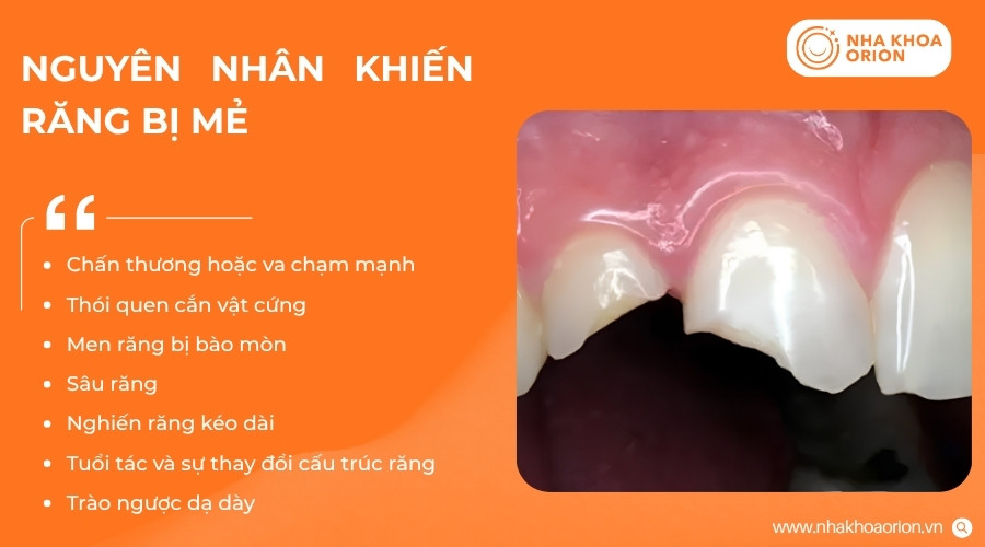 Răng bị mẻ xuất phát từ nhiều tác động làm suy yếu cấu trúc răng