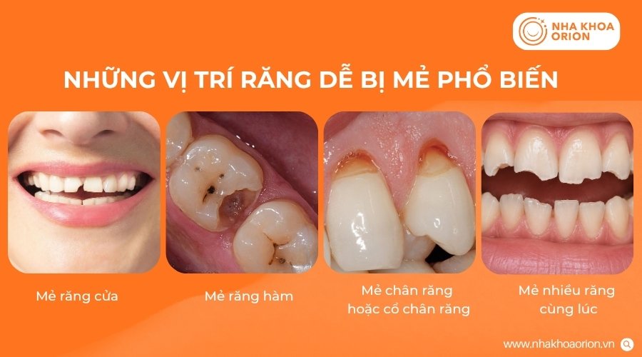 Răng bị mẻ có thể xảy ra ở nhiều vị trí với mức độ tổn thương khác nhau