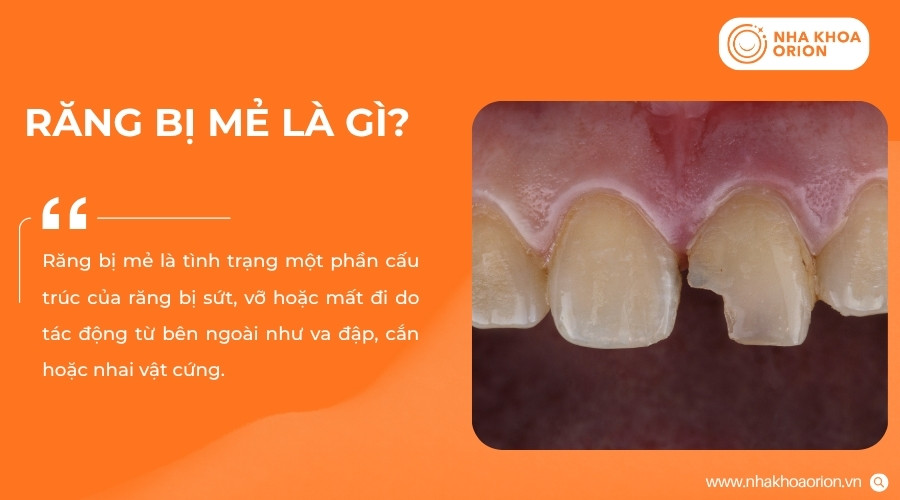 Răng bị mẻ xảy ra khi cấu trúc răng bị tổn thương và mất đi một phần