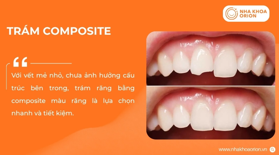 Trám răng giúp phục hồi phần mô răng bị tổn thương và cải thiện tính thẩm mỹ